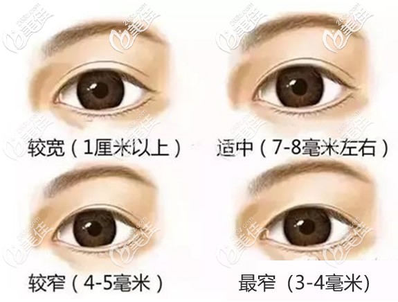 双眼皮6、7、8毫米恢复好后的宽度