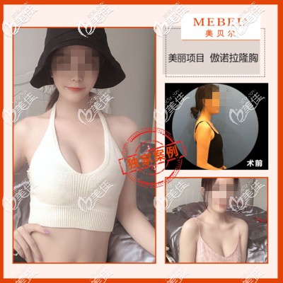 黄名斗傲诺拉假体隆胸案例 黄名斗傲诺拉假体隆胸案例