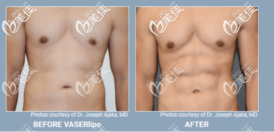 威塑超声吸脂男性案例