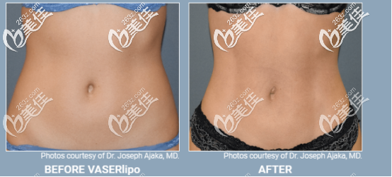 威塑超声吸脂女性案例