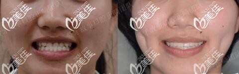 温州爱牙故事地包天牙齿矫正真人案例