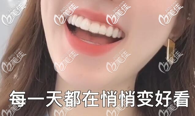 门牙太长,在郑州做牙齿矫正戴的时代天使隐形牙套价格才2万多