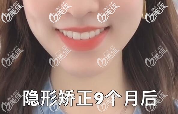 隐形矫正9个月后 隐形矫正9个月后