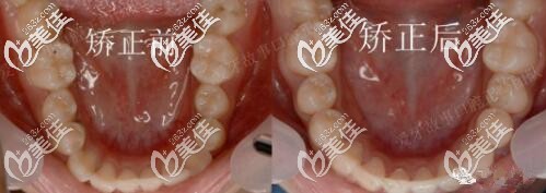 温州爱牙故事牙齿矫正真人案例