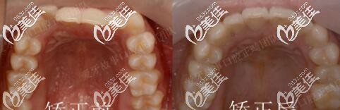 温州爱牙故事口腔门诊部正畸真人案例