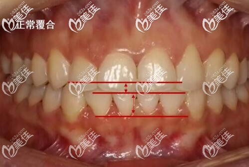 牙齿正常咬合图 牙齿正常咬合图