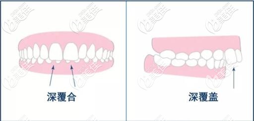 深覆合和深覆盖区别图片 深覆合和深覆盖区别图片