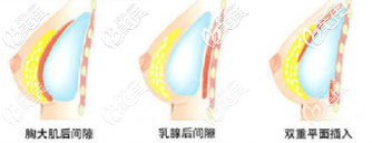 双平面假体隆胸植入层次示意图