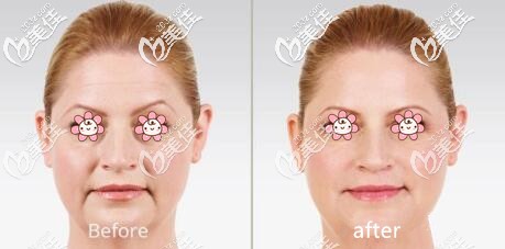 去除法令纹案例