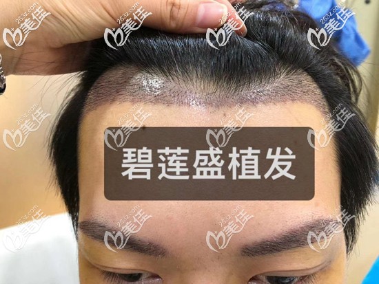 男士种植眉毛亲身经历 男士种植眉毛亲身经历