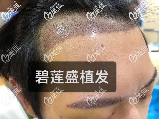 手术采用了微针种植技术 手术采用了微针种植技术