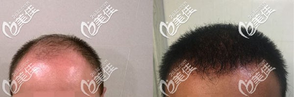 大面积植发5300毛囊单位术后8个月对比效果图 大面积植发5300毛囊单位术后8个月对比效果图