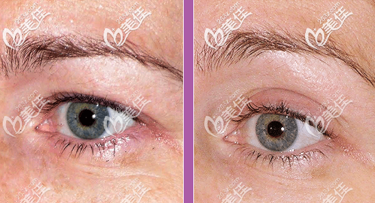 热玛吉治疗眼部皱纹的图片