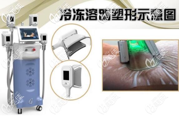 酷塑冷冻溶脂示意图 酷塑冷冻溶脂示意图