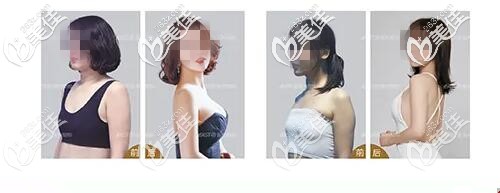 极速丰胸真人案例