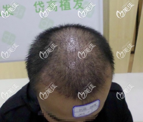 微针头顶加密种植 微针头顶加密种植