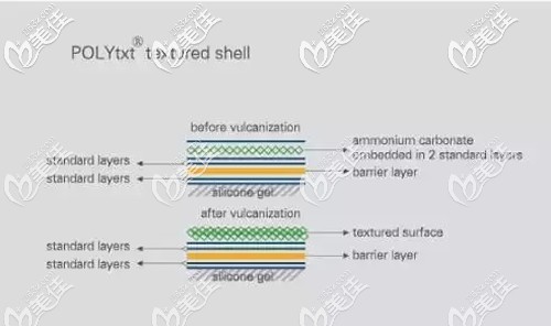 德国宝俪假体隆胸优势