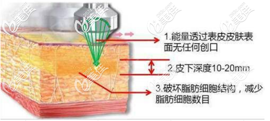 超声吸脂的过程