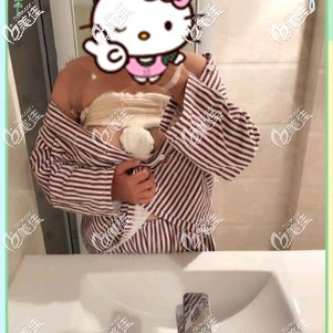 做完蓝贝假体隆胸术后即刻