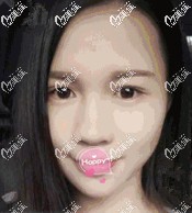 术前下巴短缩显得土气 术前下巴短缩显得土气