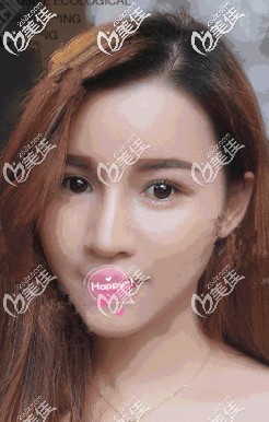 听网友说垫下巴千万不要用假体很费解 我想说亲自体验万和硅胶丰下巴效果不仅自然还不贵