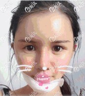 假体垫下巴术后拆线 假体垫下巴术后拆线