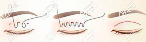 原生双眼皮手术过程示意图 原生双眼皮手术过程示意图
