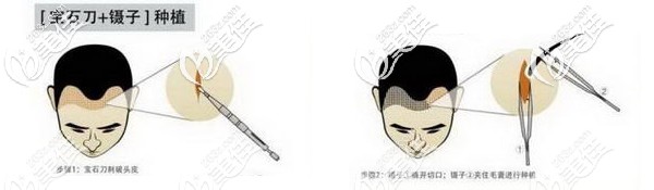 fue无痕植发技术手术过程