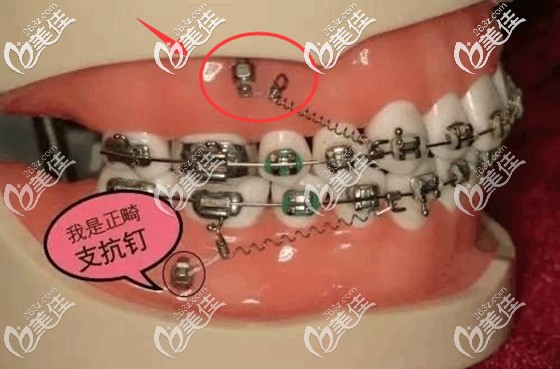 正畸支抗钉示意图