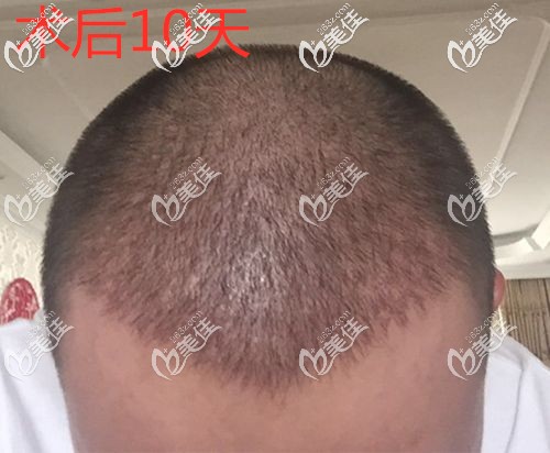 加密植发10后长出了新发茬
