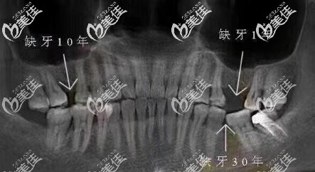 牙齿缺失邻牙倾倒
