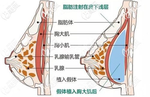 医生给出复合式隆胸手术原理
