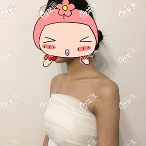 复合隆胸术后即刻胸部饱满