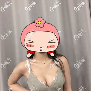 隆胸术后26天肿胀渐消