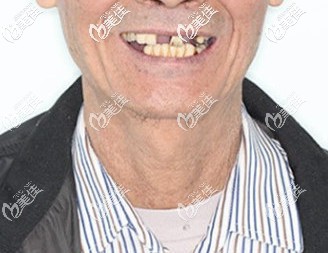 王叔种牙前口腔状况 王叔种牙前口腔状况