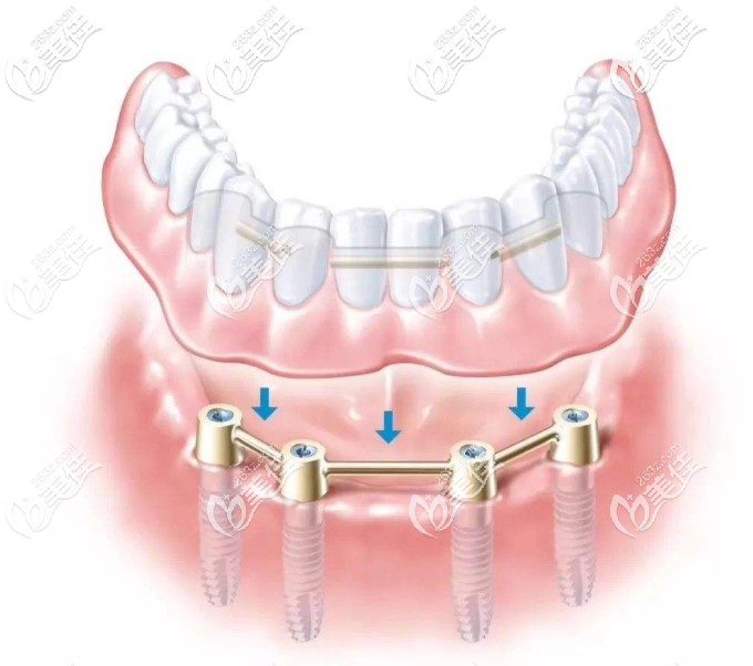 下半口allon4种植示意图 下半口allon4种植示意图