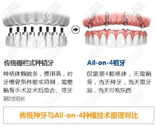 allon4半口种植和传统半口种植牙相对比