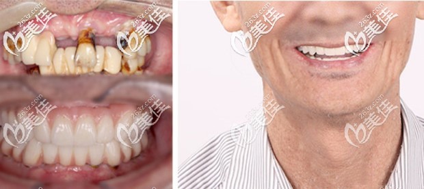 上6下4全口种牙真人案例，70岁王叔自述全口牙缺失后在深圳福田做全口即刻负重种植牙感受