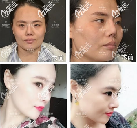 北京柏丽李劲良鼻修复案例 北京柏丽李劲良鼻修复案例