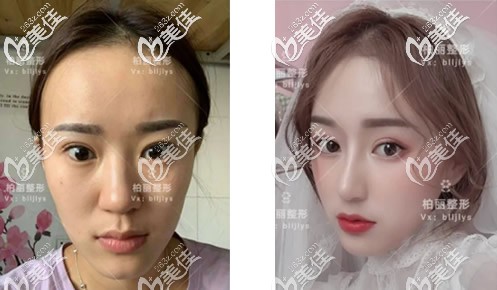 北京柏丽李劲良做鼻子怎么样 北京柏丽李劲良做鼻子怎么样