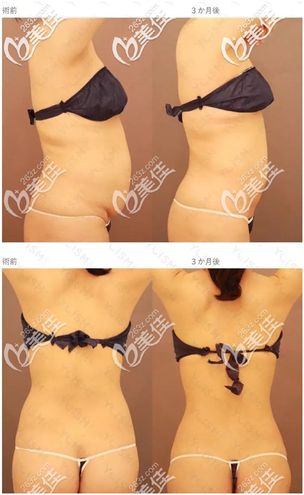 腰腹部吸脂对比案例