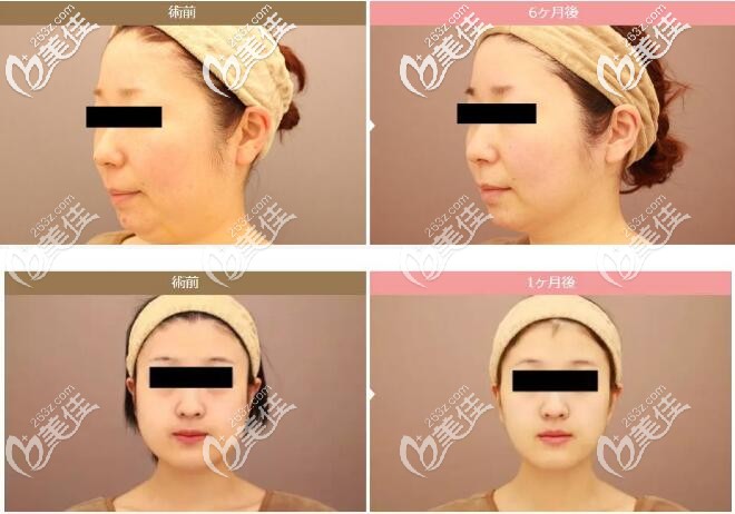 面部吸脂对比案例