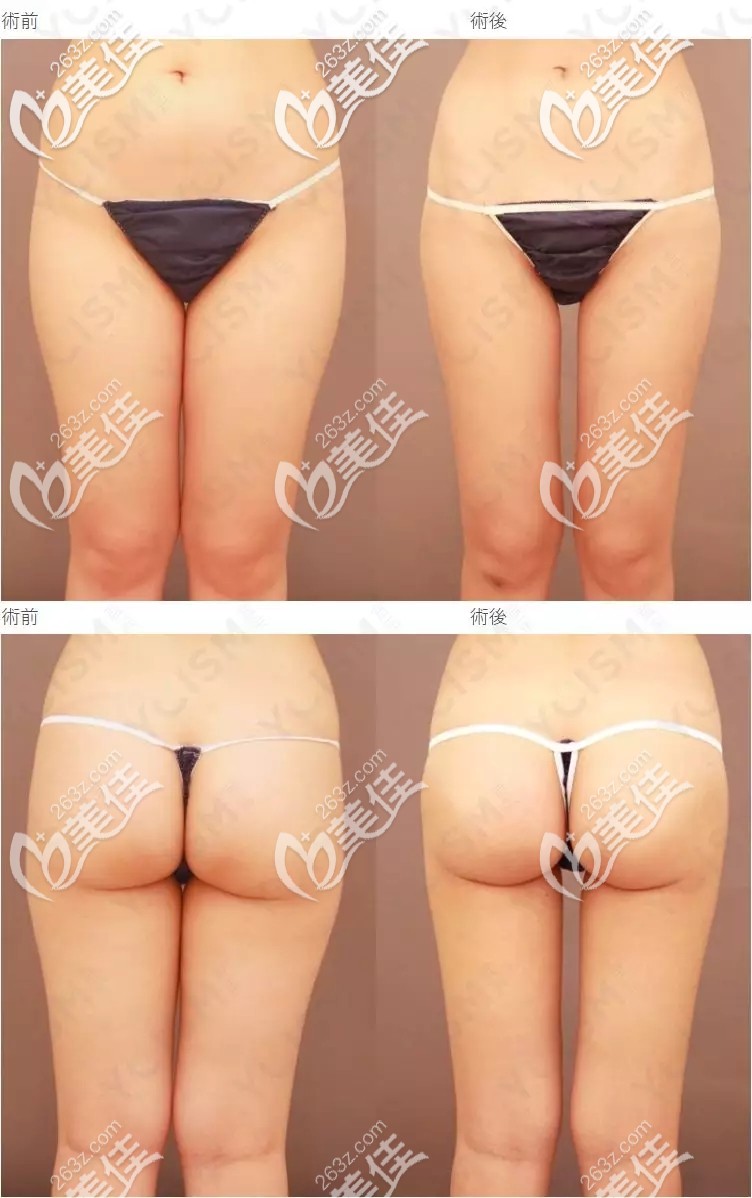 大腿臀部吸脂对比案例