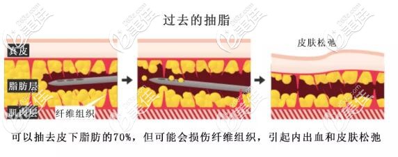 传统的抽脂方法可以去除约70%的皮下脂肪