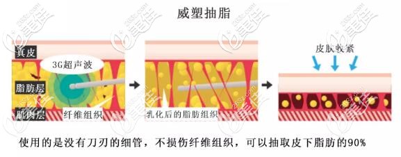 威塑抽脂是利用“ Vaser”超声波进行的吸脂的一种方法
