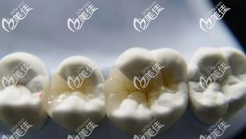 嵌体补牙