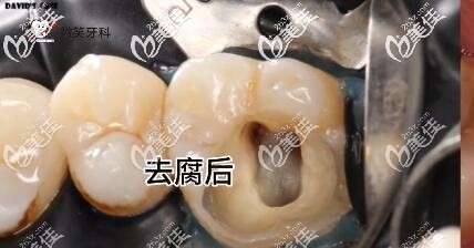 海南微笑口腔补牙真人案例