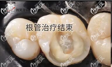 海口微笑牙科嵌体补牙真人案例