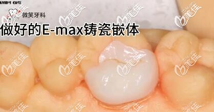 海南微笑牙科e-max瓷嵌体补牙案例