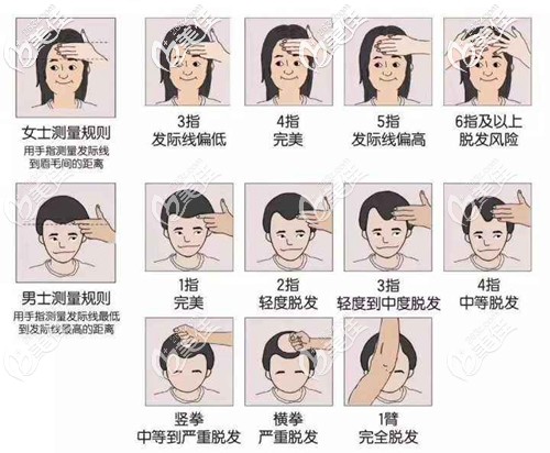 发际线手指自测图 发际线手指自测图